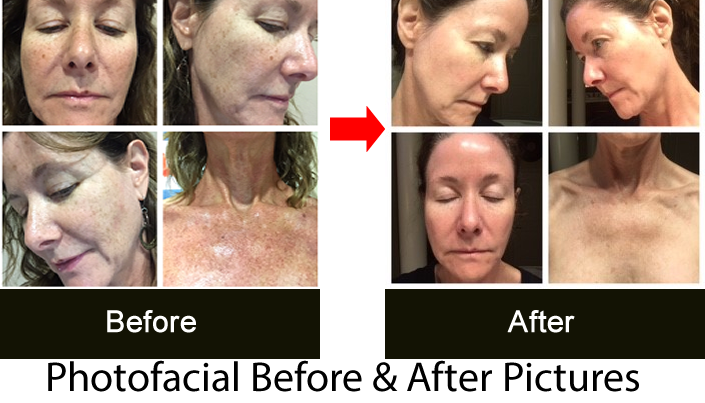 photofacial before after